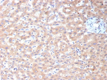IHC staining of FFPE human hepatocellular carcinoma tissue with ADH1L1 antibody (clone ALDH1L1/7959)