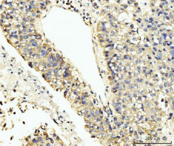 IHC staining of FFPE human liver cancer tissue with LARP4B antibody. HIER: boil tissue sections in p