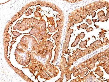 IHC analysis of formalin-fixed, paraffin-embedded human breast carcinoma stained with MUC1 antibody 