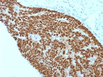 IHC testing of FFPE human colon carcinoma with CDX2 antibody (clone CDX2/1690). Required HIER: boil 