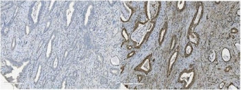 IHC staining of FFPE human gallbladder adenocarcinoma with (right) and without (left) MCM5 antibody.
