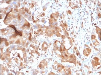 IHC testing of FFPE human hepatic carcinoma with FABP5 antibody. HIER: boiling tissue sections in pH