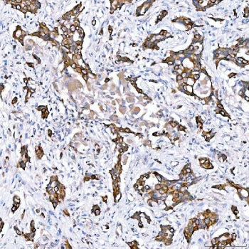 IHC staining of FFPE human lung adenocarcinoma tissue with Cytokeratin 4 antibody. HIER: boil tissue