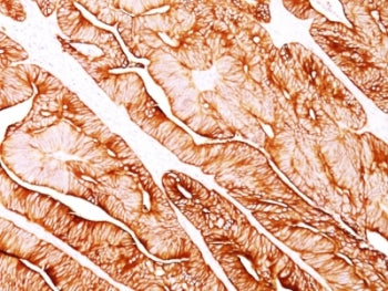 IHC analysis of formalin-fixed, paraffin-embedded human colon carcinoma stained with Cytokeratin 5/8