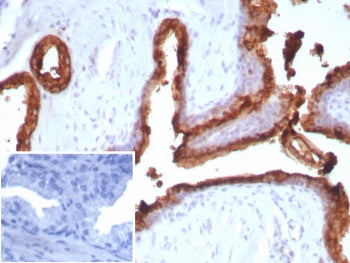 IHC staining of FFPE human prostate carcinoma tissue with ACP3 antibody (clone ACPP/2472). Inset: PB
