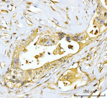 IHC staining of FFPE human appendiceal adenocarcinoma tissue with EIF3E antibody. HIER: boil tissue 