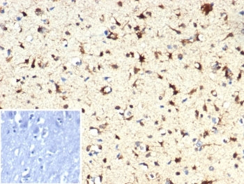 IHC staining of FFPE human brain tissue with IDH1-R132H mutation with IDH1-R132H antibody (clone IDH