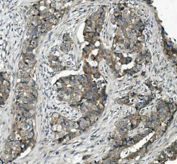IHC staining of FFPE human breast cancer with ABCC5 antibody. HIER: boil tissue sections in pH8 EDTA