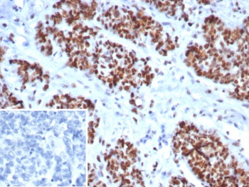 IHC staining of FFPE human ovarian cancer tissue with MSH6 antibody (clone MSH6/8338R). Inset: PBS u