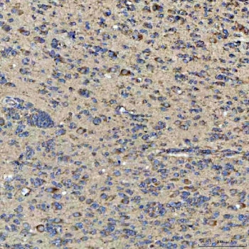 IHC staining of FFPE human glioblastoma tissue with GlnRS antibody. HIER: boil tissue sections in pH
