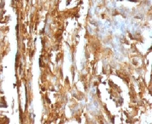 IHC testing of FFPE human renal carcinoma with B2M antibody (clone MGBP2-1). FFPE testing requires s