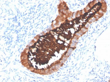 IHC staining of FFPE human ovarian carcinoma with recombinant MUC16 antibody (clone OCA125/4505R). H