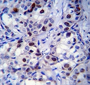 Rb antibody immunohsitochemistry analysis in formalin fixed and paraffin embedded human breast carci