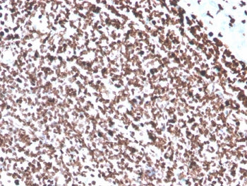 IHC: Formalin-fixed, paraffin-embedded human colon carcinoma stained with recombinant dsDNA antibody