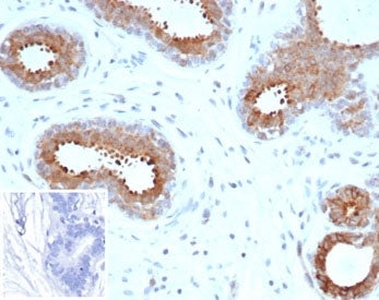 IHC staining of FFPE human breast carcinoma tissue with BAP1 antibody (clone BAP1/9795R). Inset: PBS