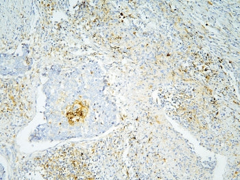 IHC staining of FFPE human lung cancer with Annexin A3 antibody at 1ug/ml. HIER: boil tissue section