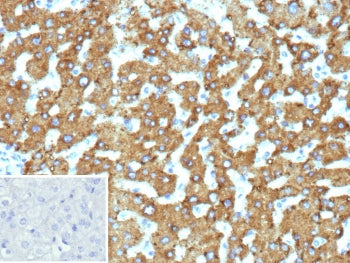 IHC staining of FFPE human hepatocellular carcinoma tissue with 17-beta-HSD 13 antibody (clone HSD17