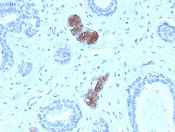 HC staining of FFPE human breast carcinoma with Mammaglobin antibody (clone MGB/4056). HIER: boil ti