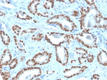 IHC staining of FFPE human prostate tissue with NKX3.1 antibody (clone NKX3.1/4562R). HIER: boil tis