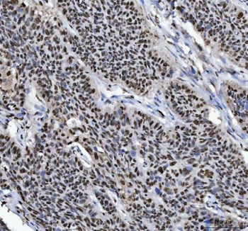IHC staining of FFPE human laryngeal squamous cell carcinoma tissue with hnRNP L antibody. HIER: boi