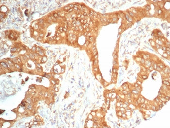 IHC staining of FFPE human colon carcinoma tissue with TrkB antibody (clone NTRK2/4673). HIER: boil 