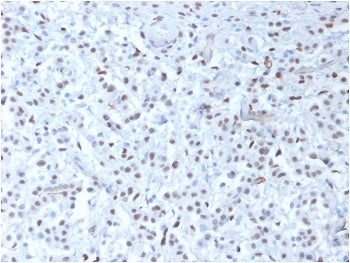 IHC testing of FFPE human mesothelioma with recombinant WT1 antibody (clone rWT1/857). Required HIER