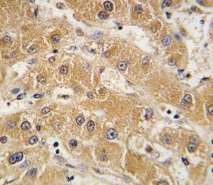 IHC analysis of FFPE human hepatocarcinoma tissue stained with APOA5 antibody.