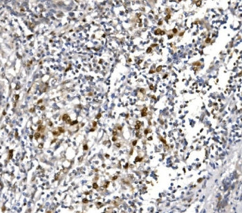 IHC staining of FFPE human lung cancer with POLR2A antibody. HIER: boil tissue sections in pH8 EDTA 