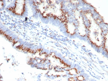 IHC staining of FFPE human colon carcinoma tissue with OVOL2 antibody (clone OVOL2/6776). HIER: boil