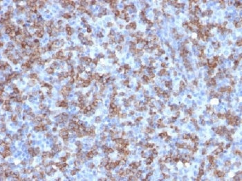 IHC testing of FFPE human lymphoma with recombinant CD8 antibody (clone C8/1779R). Required HIER: bo