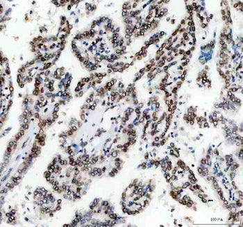 IHC staining of FFPE human lung cancer tissue with Lamin B1 antibody. HIER: boil tissue sections in 