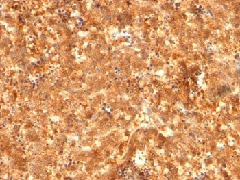 Alpha Fetoprotein / AFP Antibody Cocktail