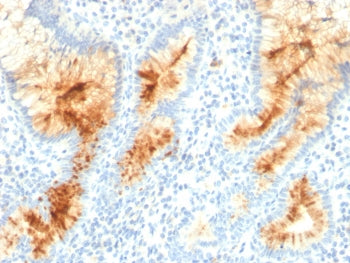 IHC testing of FFPE human gastric carcinoma with MUC4 antibody (clone MUC4/3105). HIER: requires ste