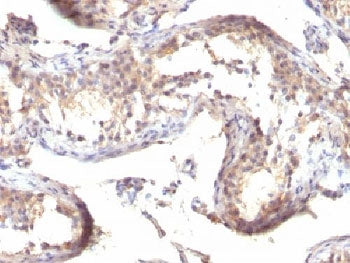 IHC testing of formalin-fixed, paraffin-embedded human testicular carcinoma stained with TGFa antibo