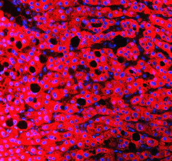 Immunofluorescent staining of FFPE human liver cancer tissue with RBP4 antibody (red) and DAPI nucle