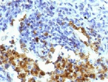 IHC testing of FFPE human lung adenocarcinoma with Napsin A antibody (clone NPSNA-1). FFPE testing r