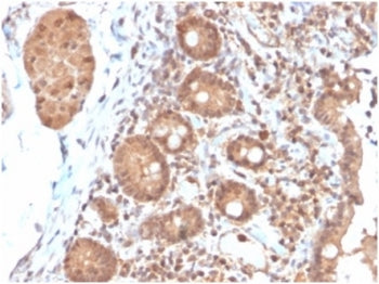 IHC staining of FFPE human colon carcinoma tissue with Interleukin 3 antibody (clone IL3/4004). HIER: boil tissue sections in pH 9 10mM Tris with 1mM EDTA for 20 min and allow to cool before testing.