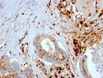 IHC staining of FFPE human liver carcinoma + macrophages with Cathepsin D antibody (clone CTSD/3082)