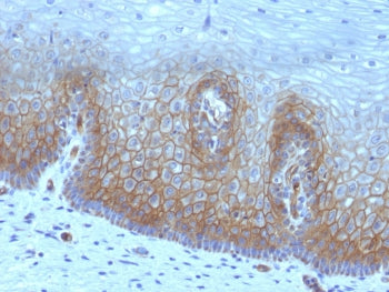 IHC testing of FFPE human cervical carcinoma with recombinant Thrombomodulin antibody (clone rTHBD/1