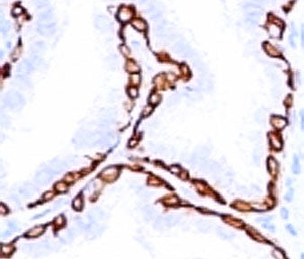 IHC: Formalin-fixed, paraffin-embedded human prostate carcinoma stained with anti-Cytokeratin 14 ant