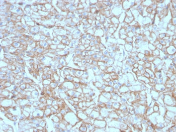 IHC testing of FFPE lung SCC with recombinant PD-L1 antibody (clone PDL1/4451R). HIER: boil tissue s