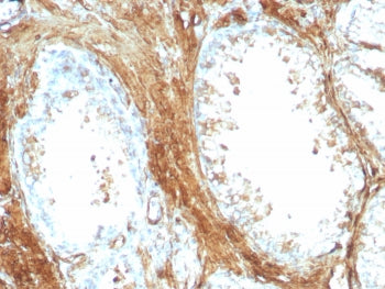 IHC staining of FFPE human prostate carcinoma tissue with recombinant Transgelin antibody (clone rTA