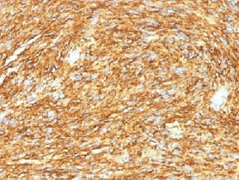 IHC testing of FFPE human gastrointestinal stromal tumor (GIST) with DOG1 antibody (DG1/1485). Requi