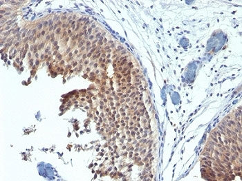 IHC: Formalin-fixed, paraffin-embedded human bladder carcinoma stained with Cytokeratin 6 antibody (