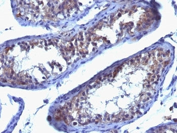 IHC: Formalin-fixed, paraffin-embedded human testicular carcinoma stained with anti-Prolactin Recept