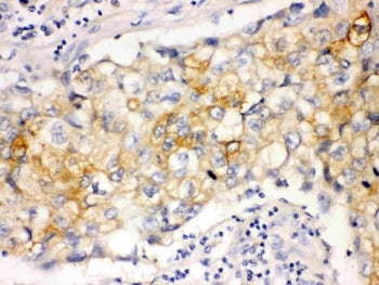 IHC staining of FFPE human lung cancer tissue with Involucrin antibody. HIER: boil tissue sections i