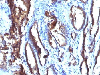 IHC staining of FFPE human prostate carcinoma with PSA antibody (clone 3E6). HIER: boil tissue secti