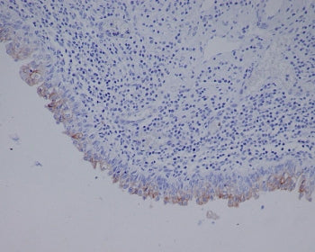 IHC staining of FFPE human bladder cancer tissue with Uroplakin III antibody. HIER: boil tissue sect