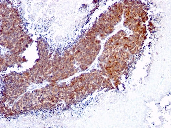 IHC staining of FFPE human melanoma with TOP1MT antibody (clone TOP1MT/613). HIER: boil tissue secti