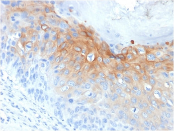 IHC staining of FFPE human cervical carcinoma with CK1 antibody (clone KRT1/1840). HIER: boil tissue